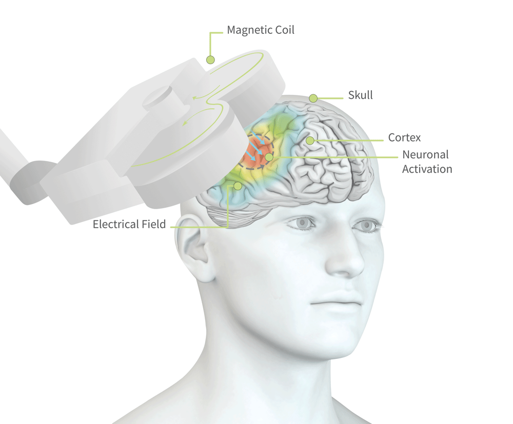 rtms-treatment-effective-tms-therapy